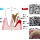 歯石はプラークの住処（すみか）！！