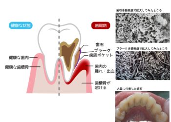 歯石はプラークの住処（すみか）！！