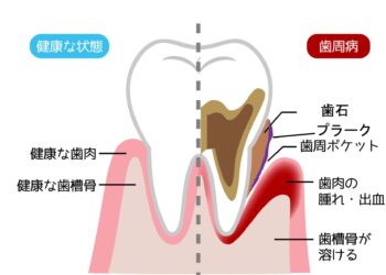歯石はプラークの住処(すみか)!!
