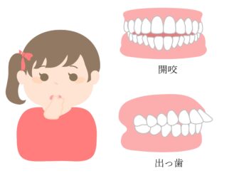 指しゃぶりをやめさせるのはいつ？？？