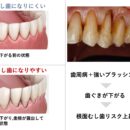 根面むし歯を防ぐために今日からできること