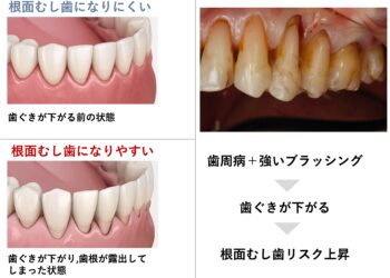 根面むし歯を防ぐために今日からできること