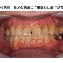むし歯は増えている？その理由は“高齢化”
