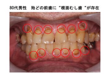 むし歯は増えている？その理由は“高齢化”