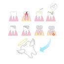 歯を失う本当の原因とは?