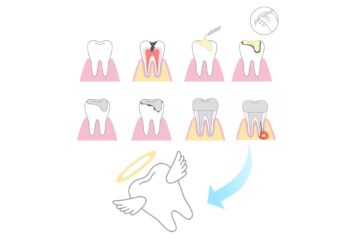 歯を失う本当の原因とは?