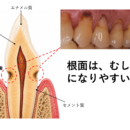 【知らないと危険】根面むし歯が“気づかないうちに進行する”本当の理由