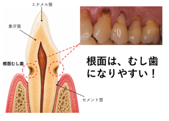【知らないと危険】根面むし歯が“気づかないうちに進行する”本当の理由