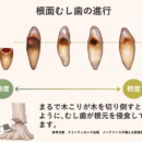【見逃しがち】根面むし歯の初期症状チェック