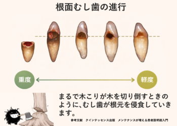 【見逃しがち】根面むし歯の初期症状チェック