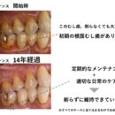 初期の根面むし歯は削らない方がいい？見極めが重要な理由