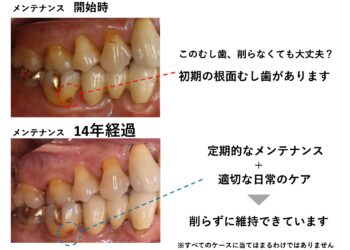 初期の根面むし歯は削らない方がいい？見極めが重要な理由