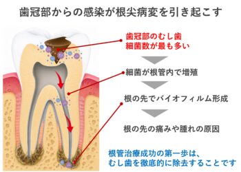 根管治療を成功に導くために本当に大切なこと