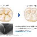 歯磨きだけでは守れない場所があります―シーラントが必要な理由