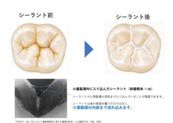 歯磨きだけでは守れない場所があります―シーラントが必要な理由
