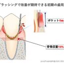 ブラッシングだけで歯周病は改善できるか?