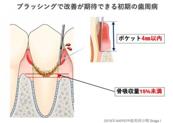 ブラッシングだけで歯周病は改善できるか？