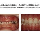 子どものむし歯や歯肉炎が、将来の健康に関係するかもしれません〜57万人を20年以上追跡した研究から〜