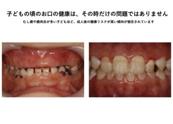 子どものむし歯や歯肉炎が、将来の健康に関係するかもしれません〜57万人を20年以上追跡した研究から〜